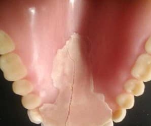 Why Not To Repair Your Dentures At Home