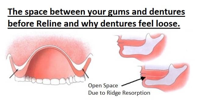 Upper Denture Reline Kit