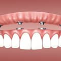 9 Important Considerations When Getting Partial Dentures